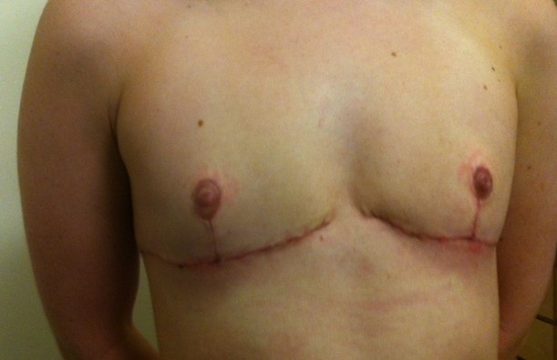 chest-month1-2 1 month post-op top surgery