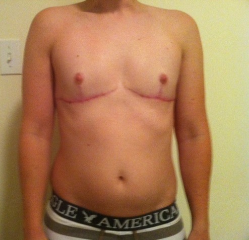 FTM Top Surgery Post-Op