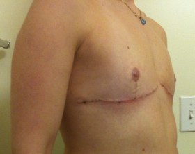 Top Surgery Week 3