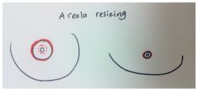 FTM Top Surgery Areola Resizing