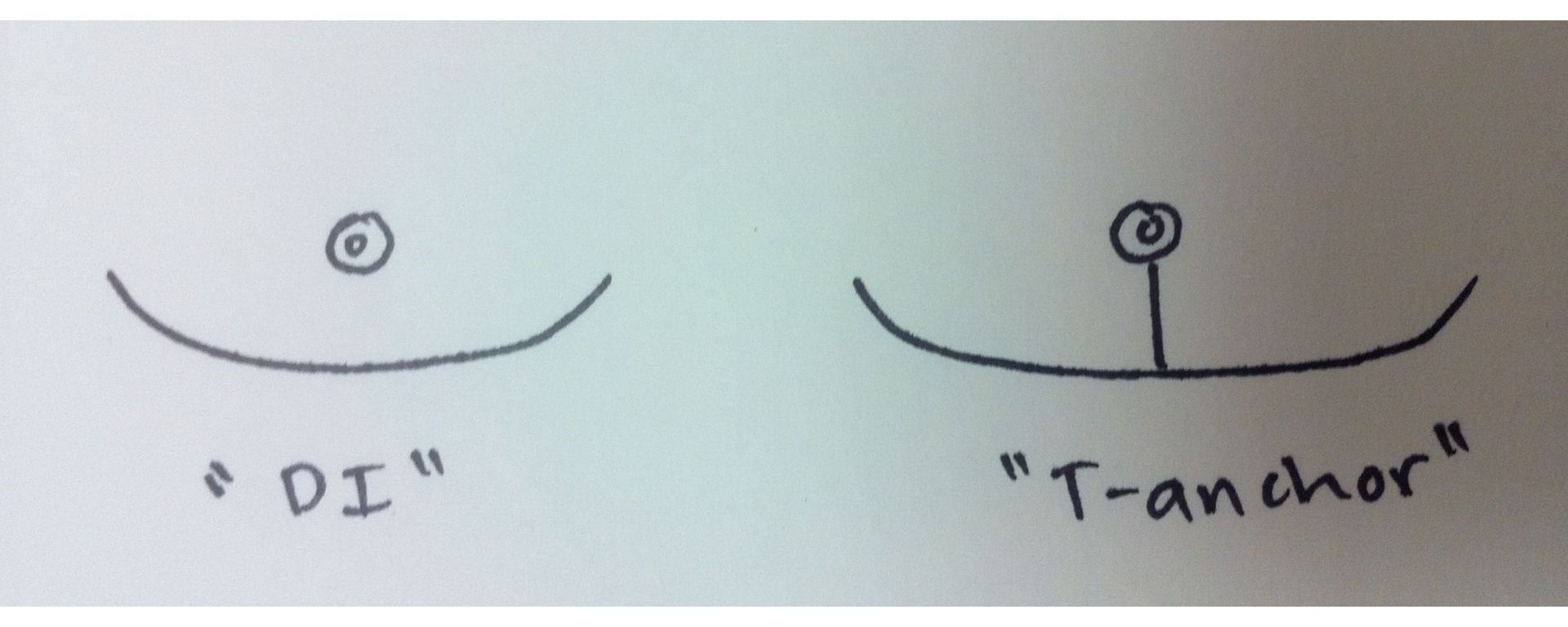 Double Incision vs T-Anchor