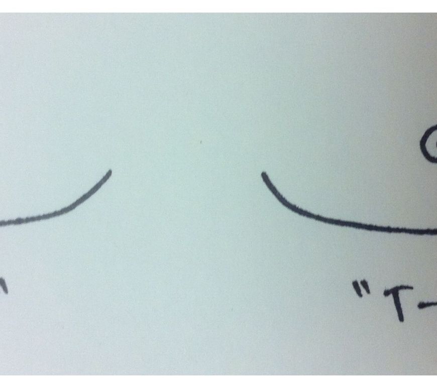 Double Incision vs T-Anchor