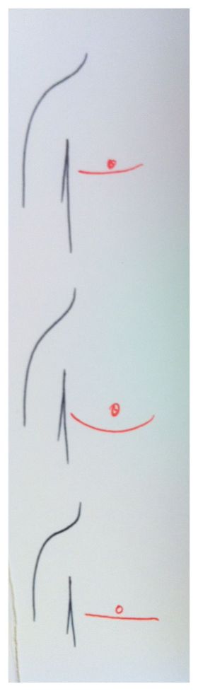 FTM Top Surgery DI Positioning