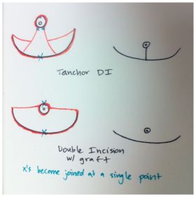 FTM Top Surgery Double Incision