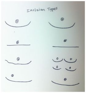 FTM Top Surgery DI Incision